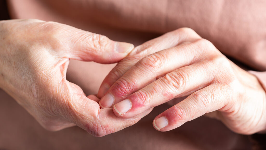 STAT+: Talawar bets bispecific approach can shake up eczema market