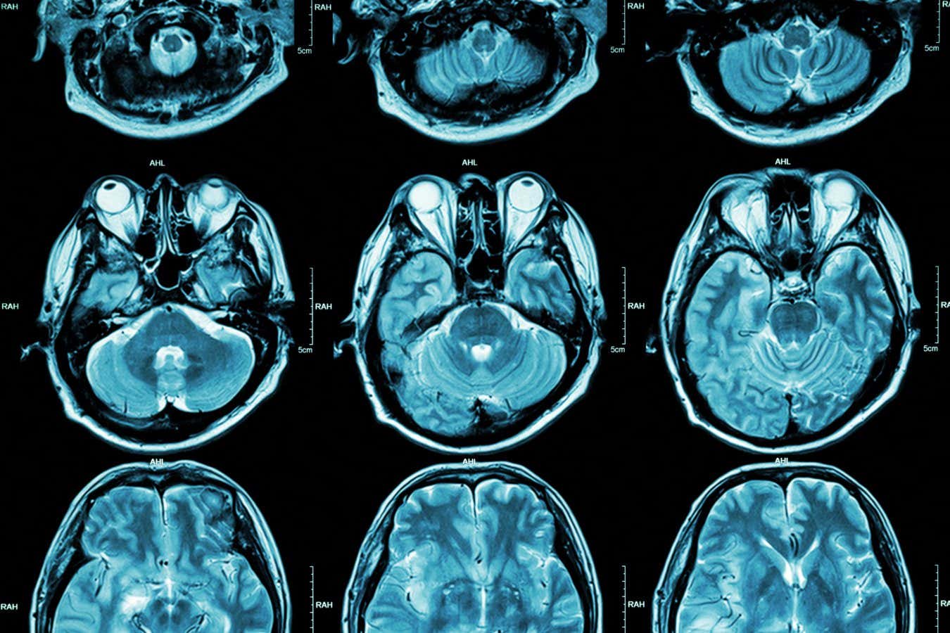 Autism may have two distinct subtypes that vary by brain activity
